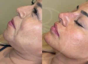 Bichectomia sin Cirugía Armonización Facial